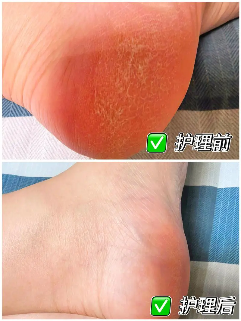 手脚干裂是什么原因