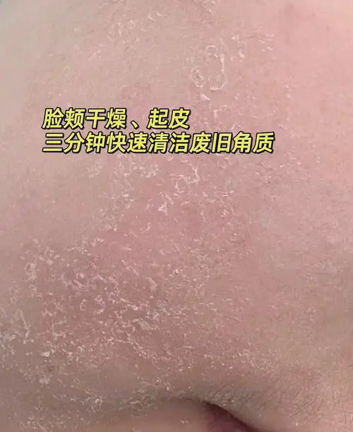 脸上起皮是为什么