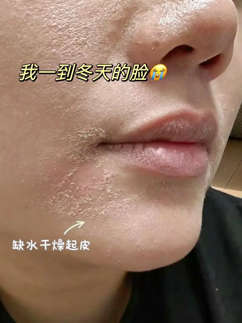 脸上起皮是为什么