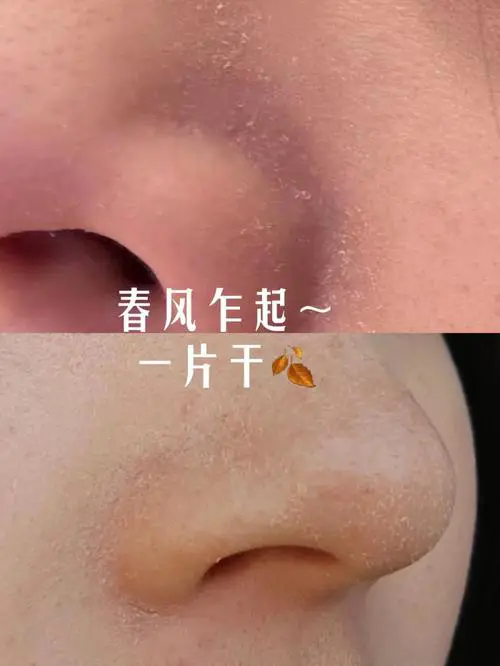 用洗面奶怎么脸上脱皮