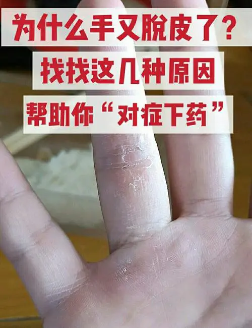 手死皮是什么原因