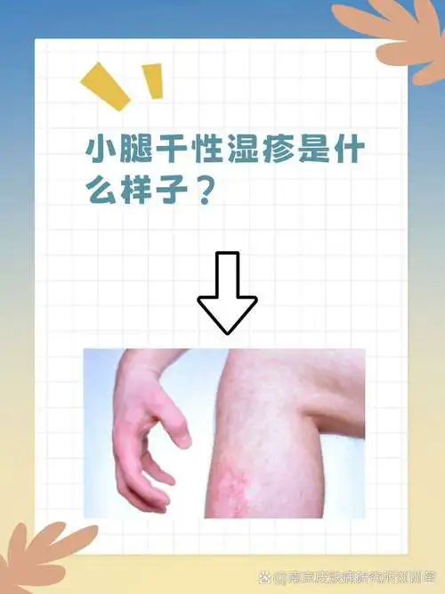 什么是干性湿疹