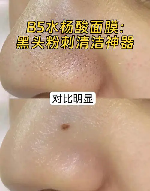 粉刺黑头面膜怎么样
