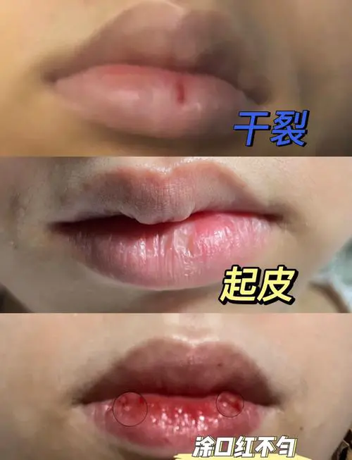 嘴角干裂是什么原因
