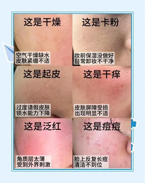 皮肤干燥起皮什么原因