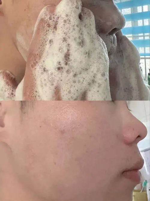 洗面奶脸上出痘痘怎么回事