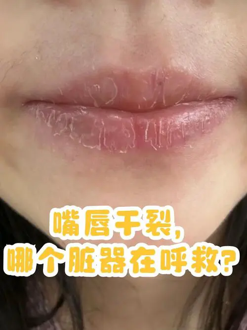 嘴角干裂是什么原因