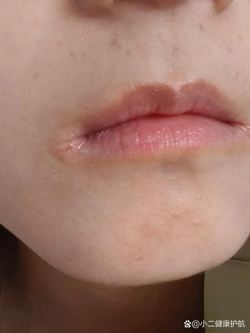 嘴巴开裂是什么原因