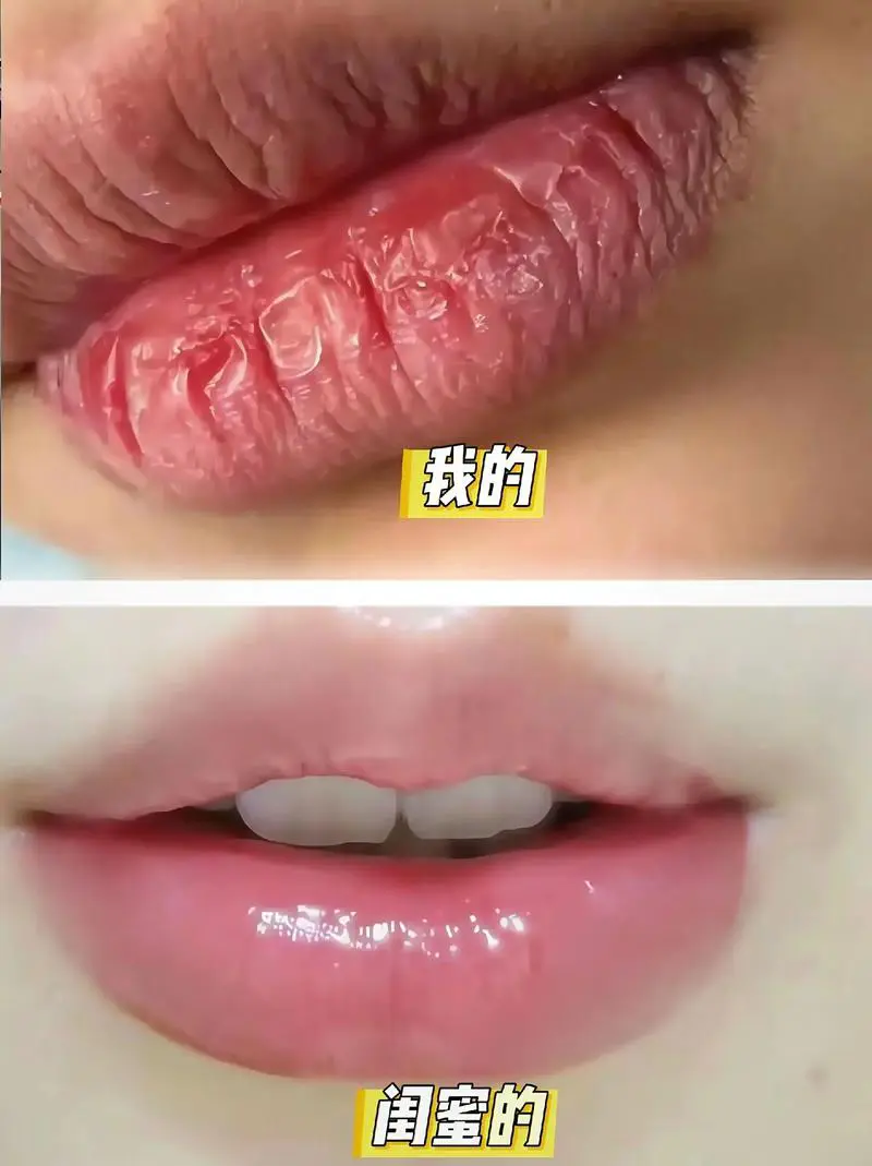 嘴唇干裂脱皮什么原因