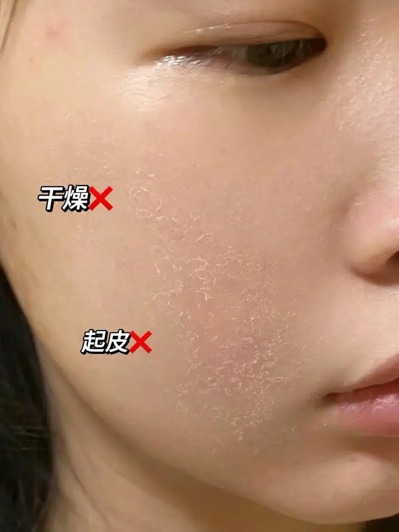 为什么秋天皮肤干燥