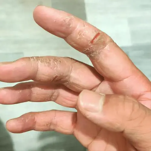 手掌干燥是什么原因