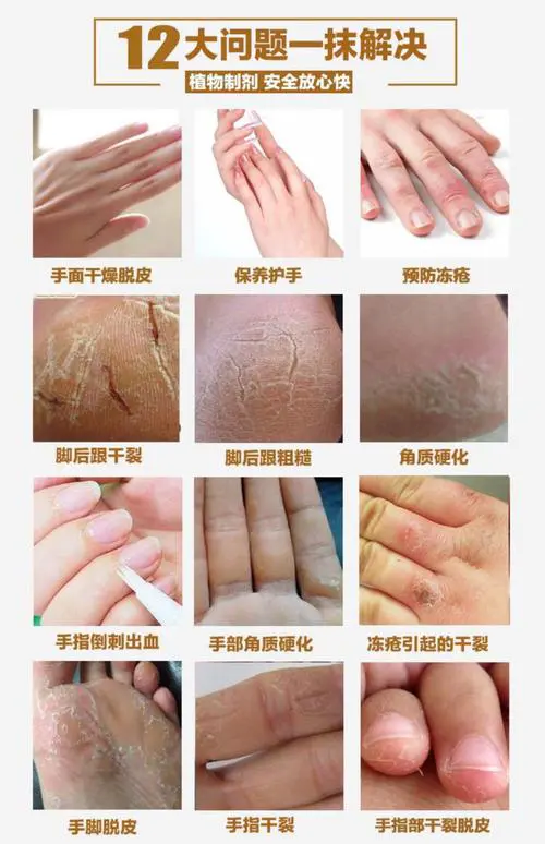 手脚干裂是什么原因