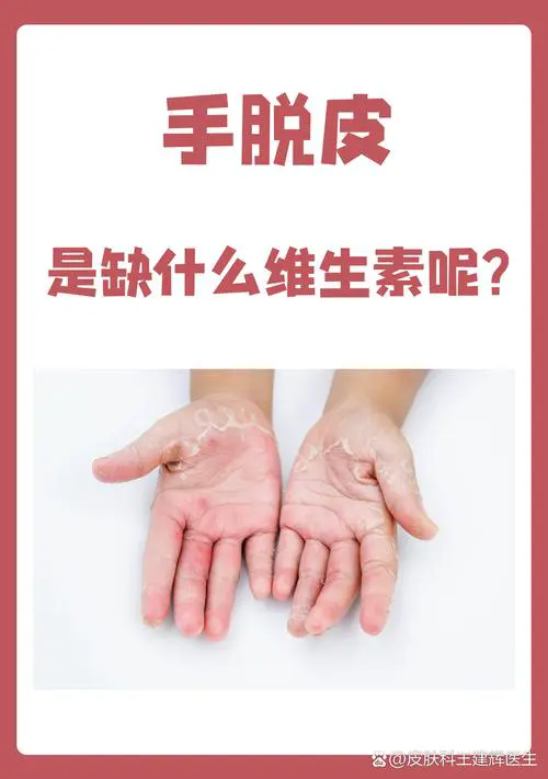 手掌干燥是什么原因