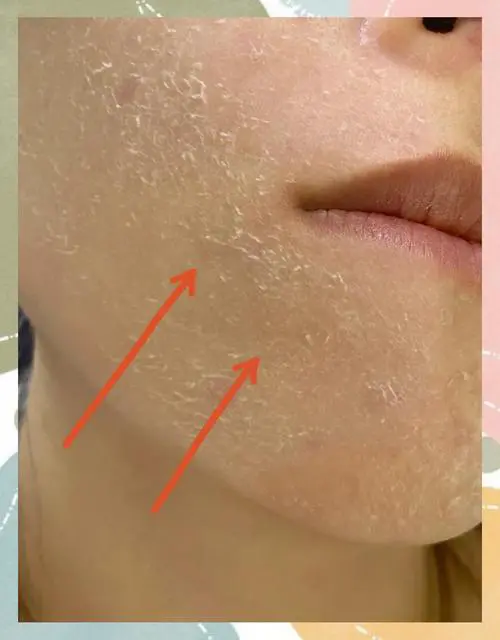 用洗面奶怎么脸上脱皮