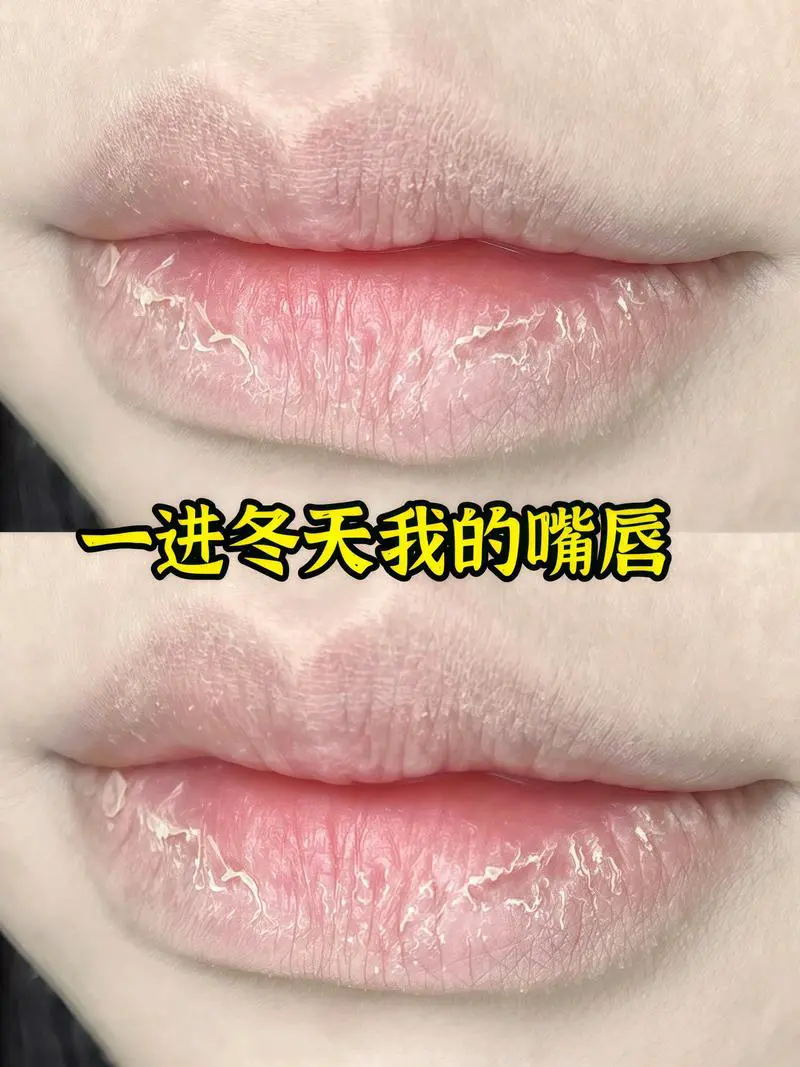 嘴唇干裂擦什么好