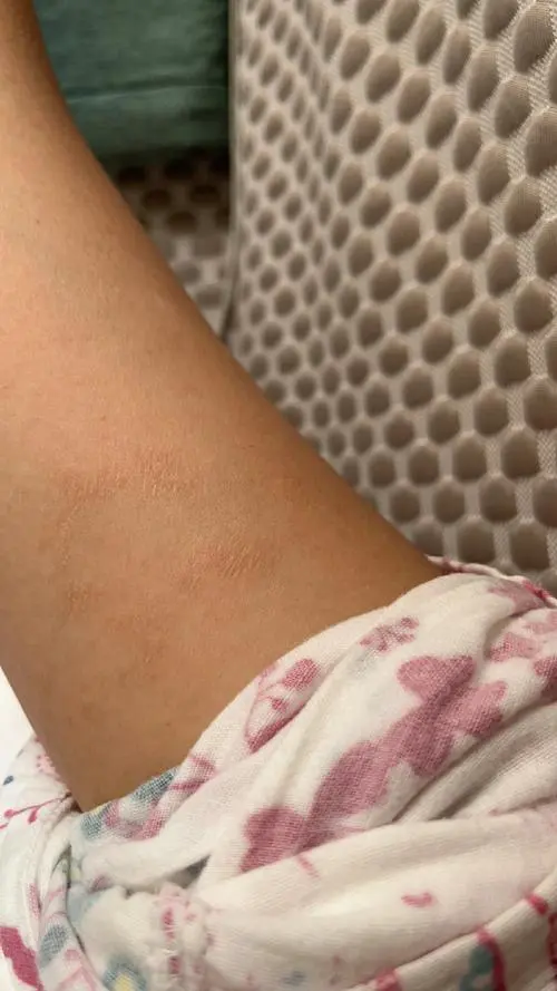 什么是干性湿疹