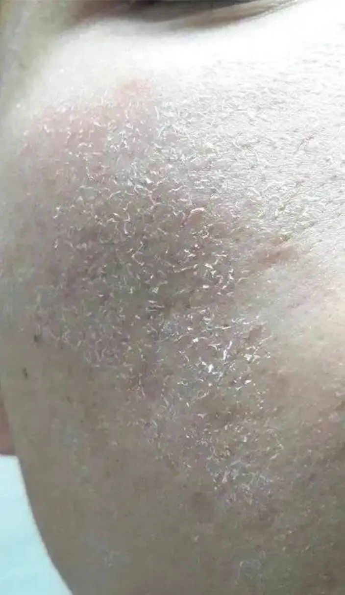 脸上起皮是为什么