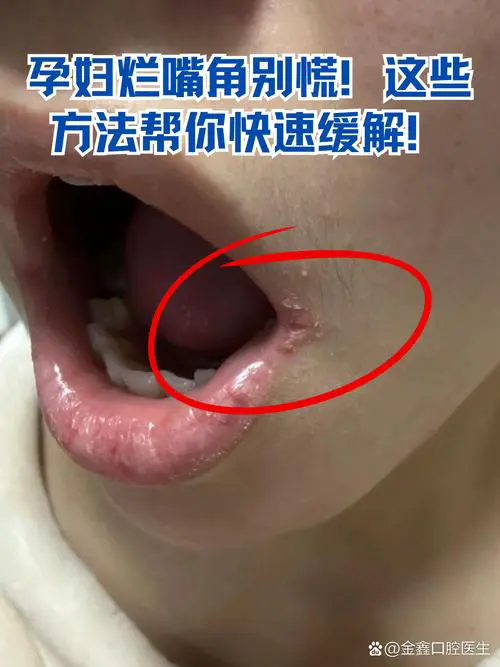 嘴巴开裂是什么原因