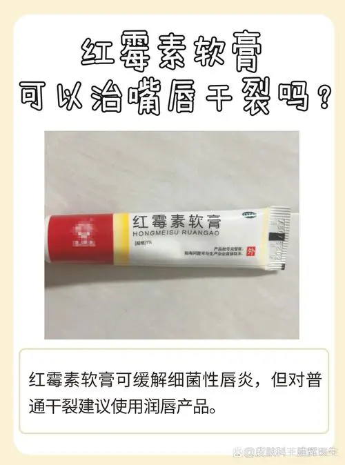 嘴唇干裂擦什么好