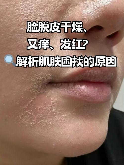 脸部起皮是什么原因