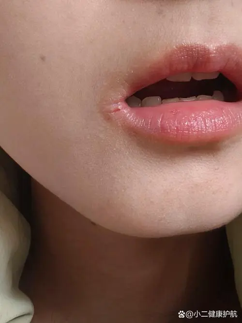嘴巴开裂是什么原因