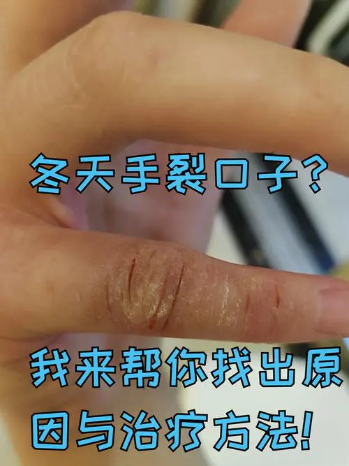 手脚开裂是什么原因