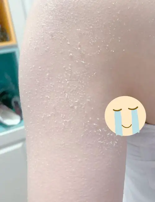 皮肤干燥有什么办法