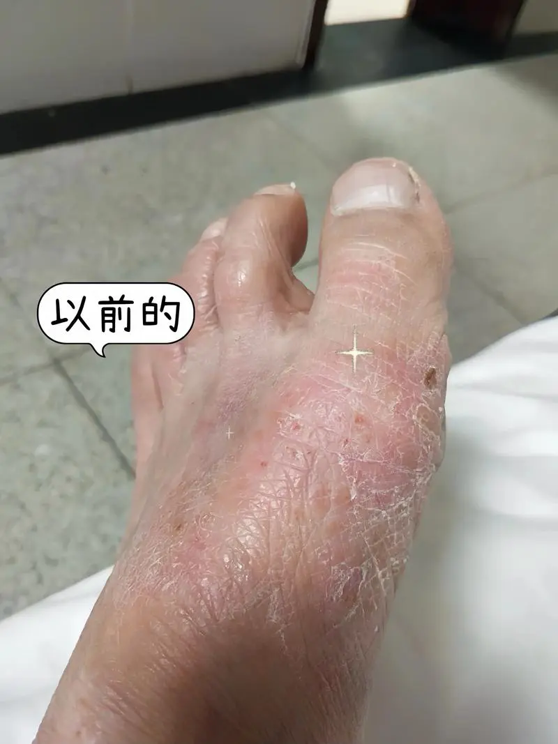 手脚开裂是什么原因