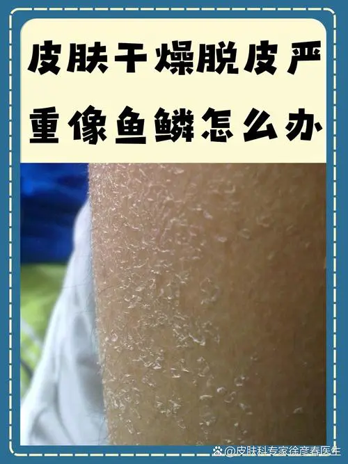 皮肤干燥起皮什么原因