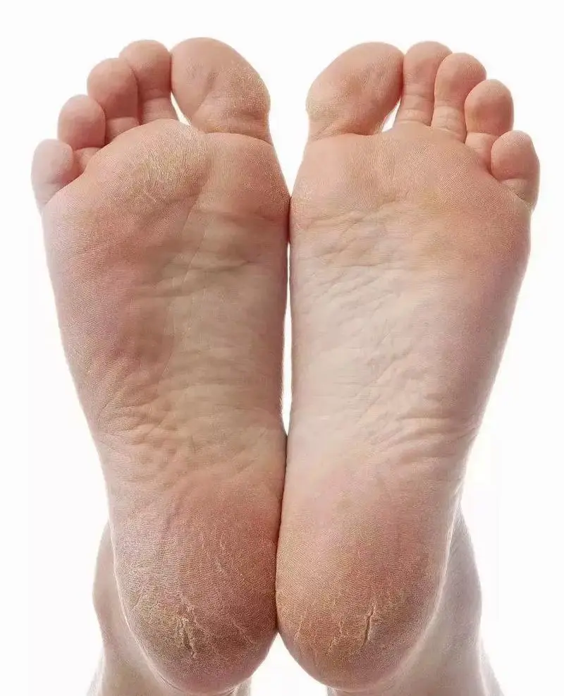 脚底干裂是什么原因