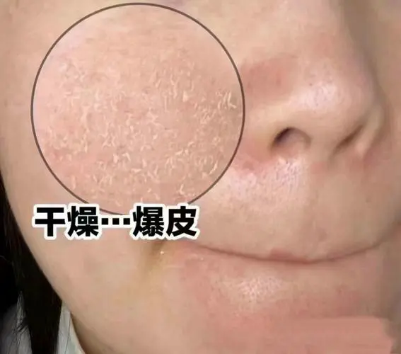 为什么秋天皮肤干燥