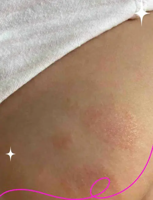 什么是干性湿疹