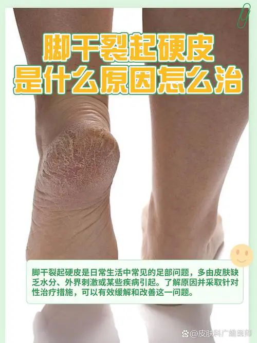 脚底干裂是什么原因