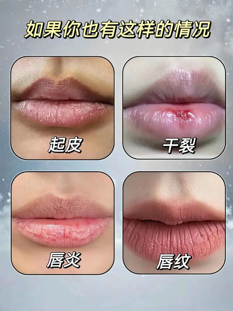 嘴唇干裂脱皮什么原因