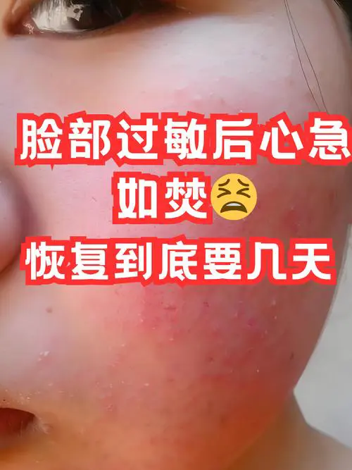 洗面奶脸过敏发红痒怎么办