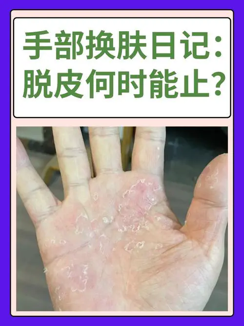 手掌干燥是什么原因