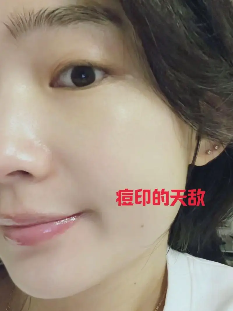 痘痘破了面膜怎么样