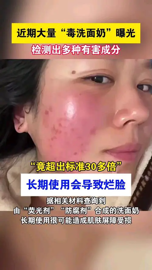 错误使用洗面奶会怎么样