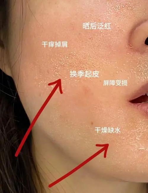 为什么脸上起干皮