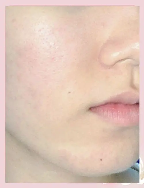 洗面奶用后脸红怎么办