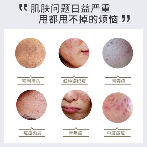 老中医痘清洗面奶怎么样