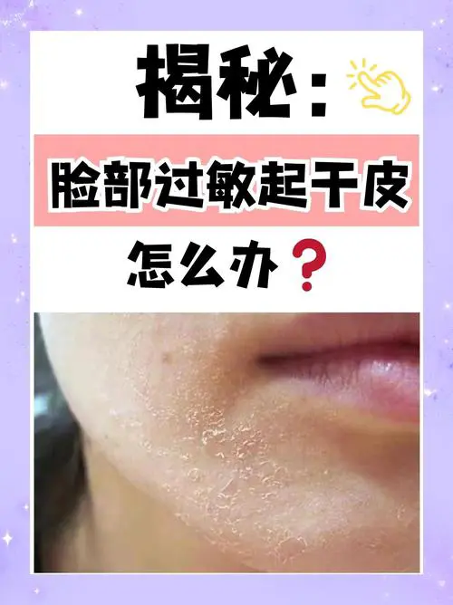 为什么脸上起干皮