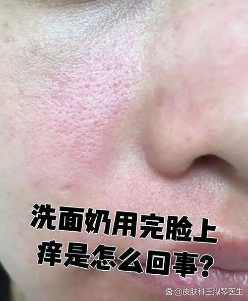 脸部一用洗面奶就过敏怎么办