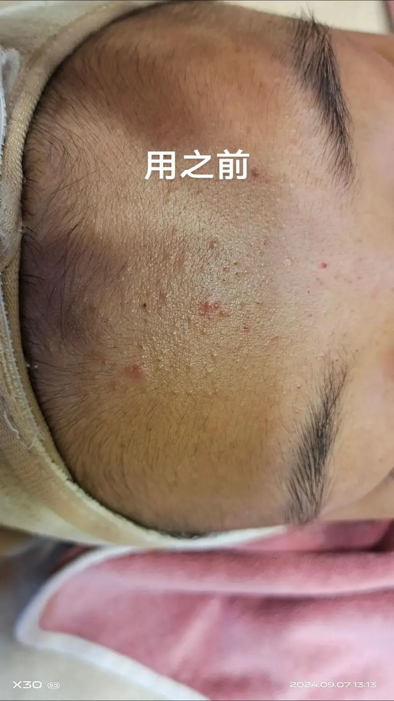 用洗面奶容易起痘痘怎么回事