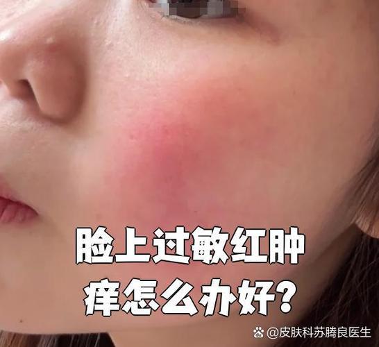 脸部一用洗面奶就过敏怎么办