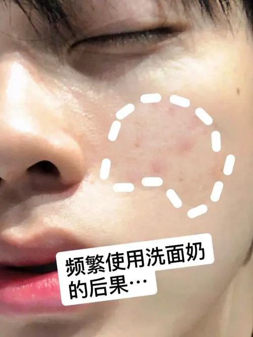 洗面奶用后过敏怎么办