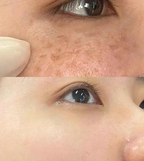 片仔癀最新祛斑怎么样