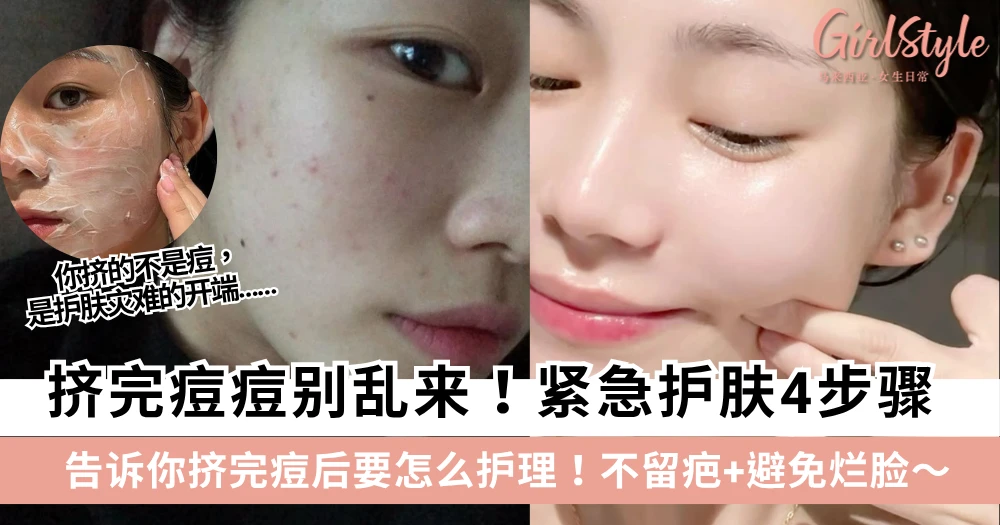 挤完痘痘别乱来!紧急护肤4步骤,跟痘痘say bye还能不留疤+避免烂脸!