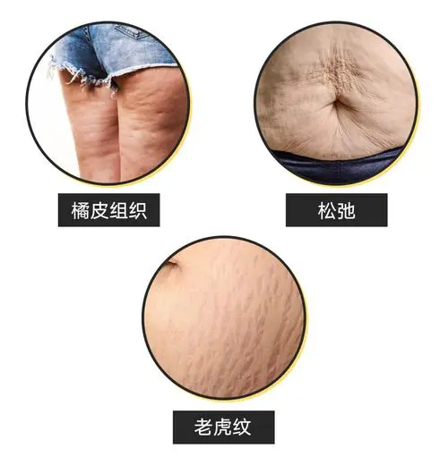 减肥后皮肤松弛擦什么好