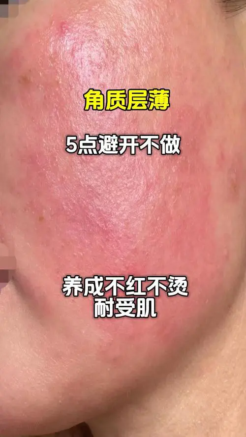 什么是角质层薄